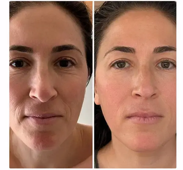 Before and after, Sculptural Face Lifting